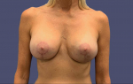 Breast Lift w/ Augmentation 9 After